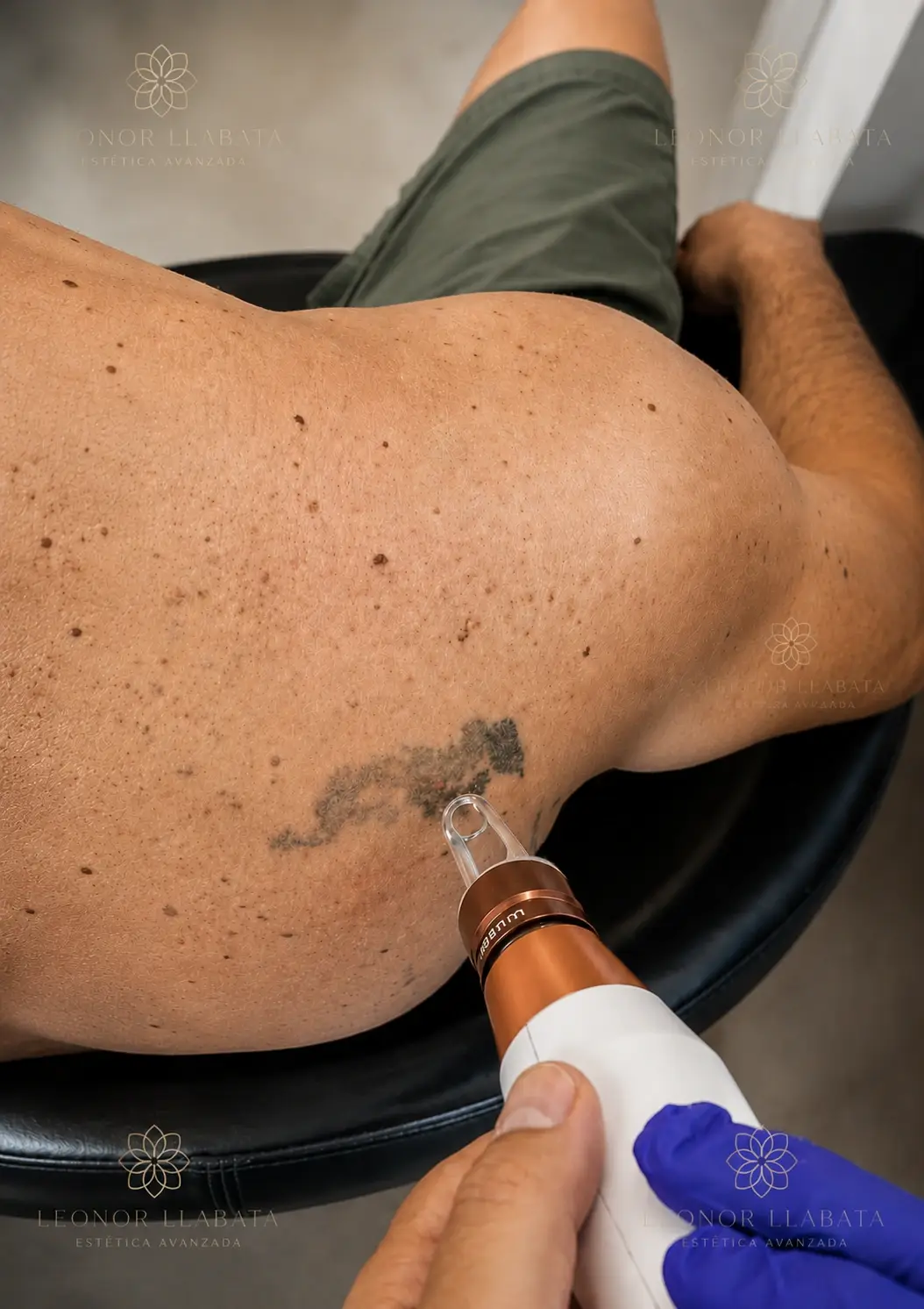 Borrado de tatuajes, tratamiento de Estética Avanzada Leonor Llabata en Mallorca