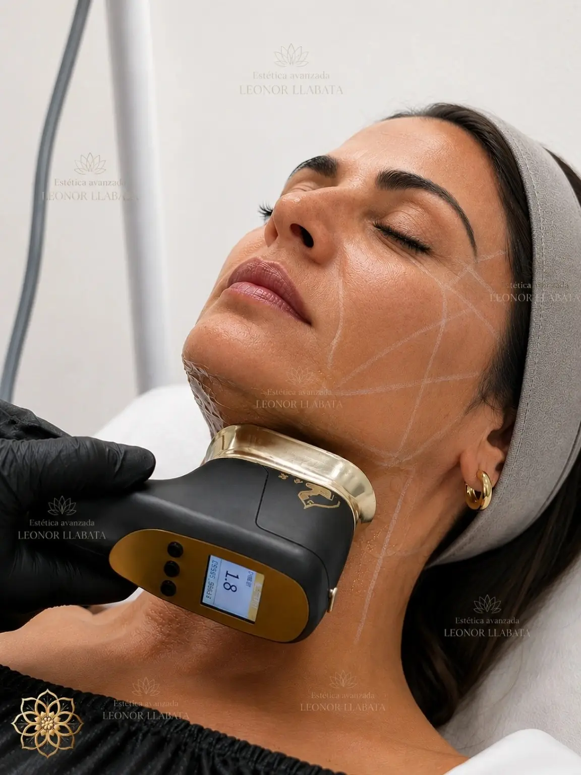 Hifu 25D, tratamiento de Estética Avanzada Leonor Llabata en Mallorca